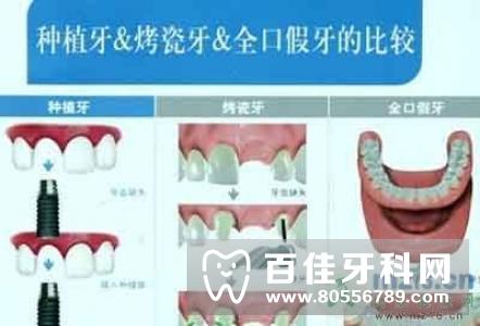 种植牙与烤瓷牙